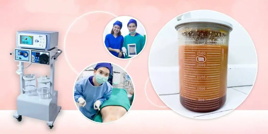 ดูดไขมัน เติมไขมัน Amara Liposuction Center (เอมาร่า คลินิก) โดยแพทย์ผู้มีประสบการณ์