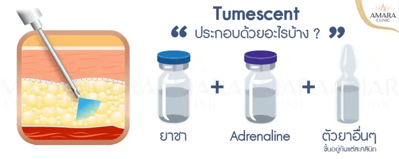 Tumescent ดูดไขมัน