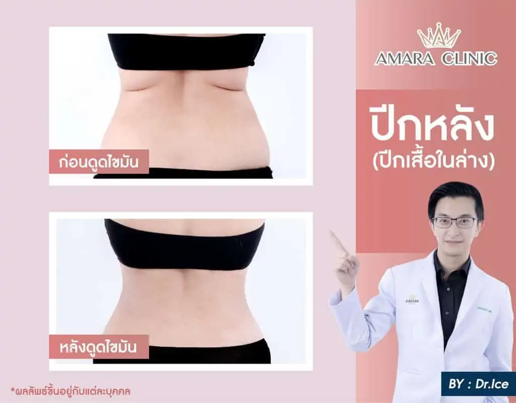 ดูดไขมัน เติมไขมัน Amara Liposuction Center (เอมาร่า คลินิก) โดยแพทย์ผู้มีประสบการณ์