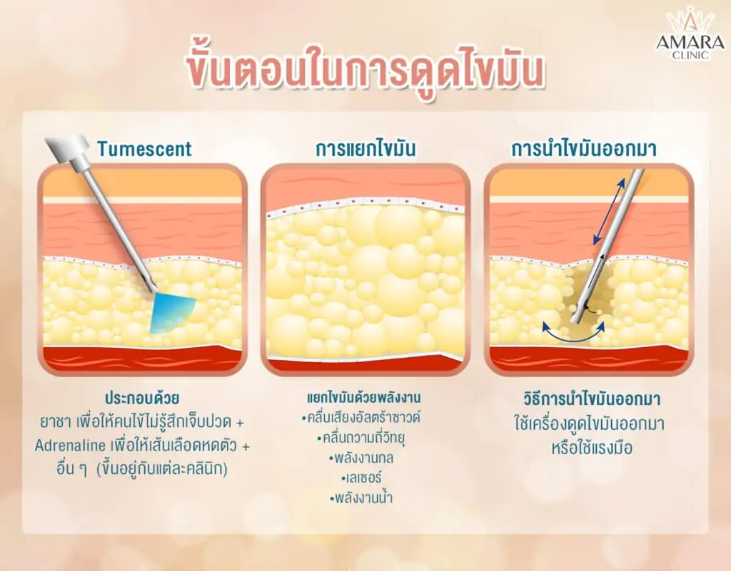 ขั้นตอนในการดูดไขมัน