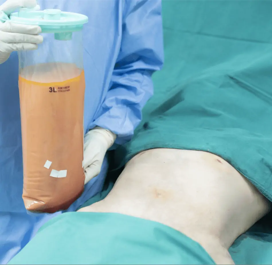 ดูดไขมัน เติมไขมัน Amara Liposuction Center (เอมาร่า คลินิก) โดยแพทย์ผู้มีประสบการณ์