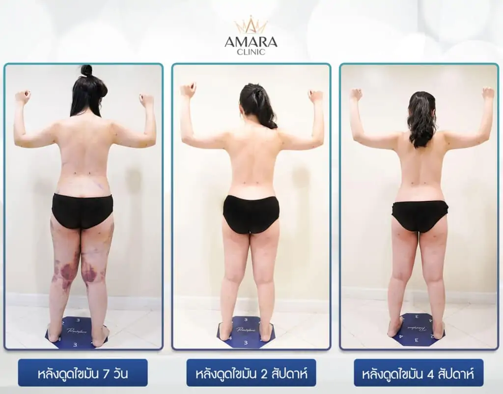 ดูดไขมัน เติมไขมัน Amara Liposuction Center (เอมาร่า คลินิก) โดยแพทย์ผู้มีประสบการณ์