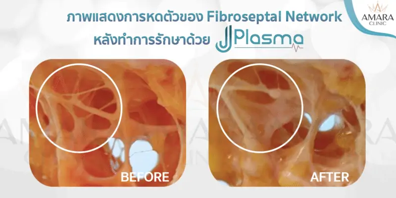 การทำงานของ J Plasma