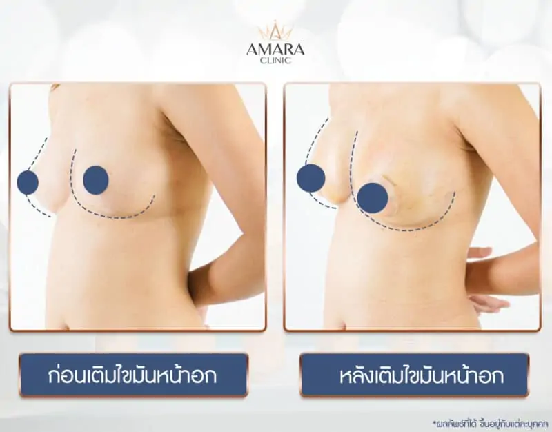 รีวิว ฉีดไขมันตัวเองเสริมทรวงอก