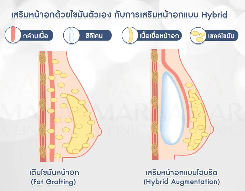 ดูดไขมัน เติมไขมัน Amara Liposuction Center (เอมาร่า คลินิก) โดยแพทย์ผู้มีประสบการณ์