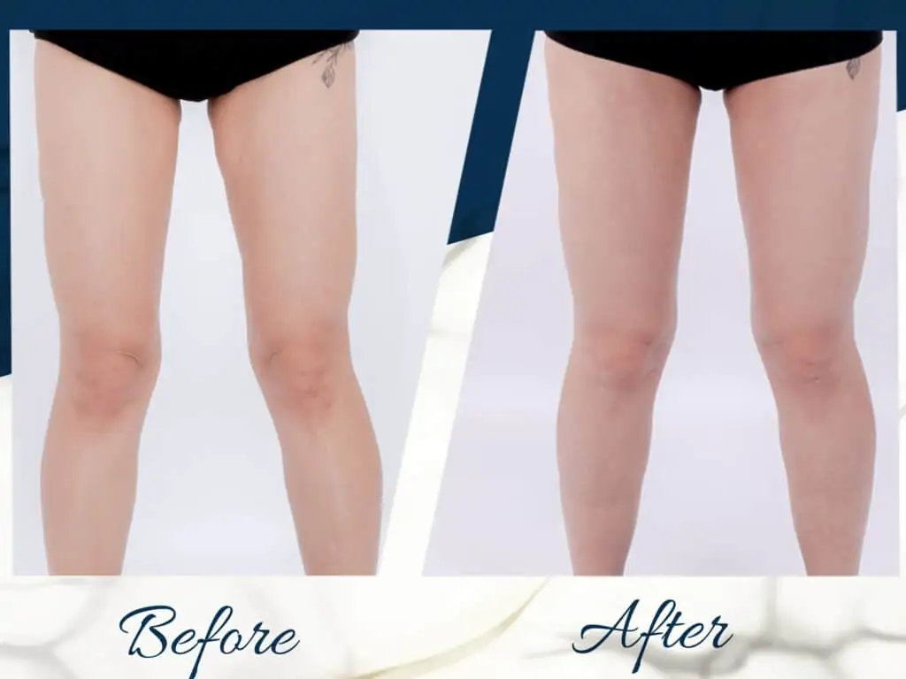 ดูดไขมัน เติมไขมัน Amara Liposuction Center (เอมาร่า คลินิก) โดยแพทย์ผู้มีประสบการณ์