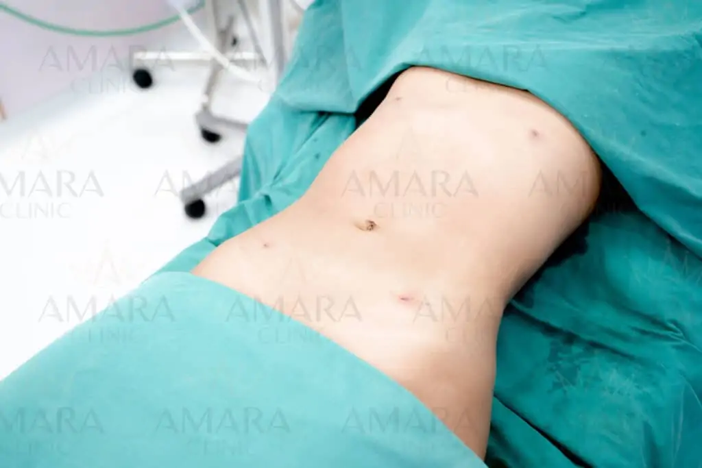 ดูดไขมัน เติมไขมัน Amara Liposuction Center (เอมาร่า คลินิก) โดยแพทย์ผู้มีประสบการณ์
