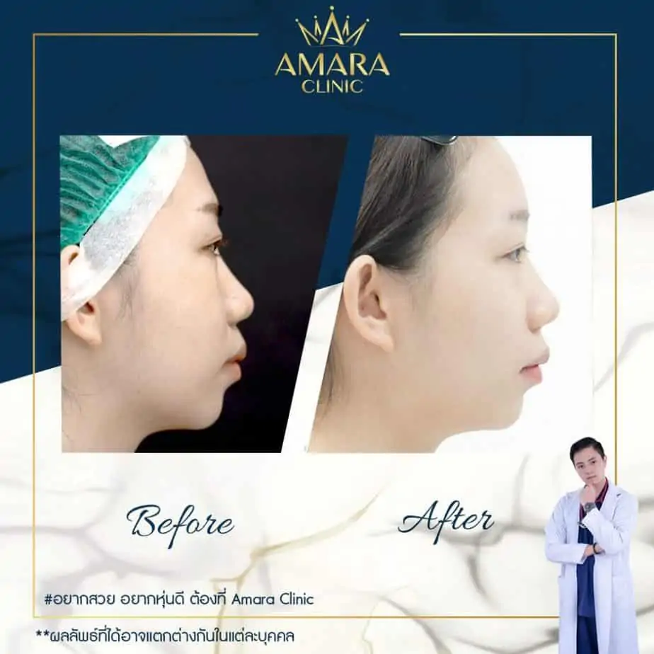 ดูดไขมัน เติมไขมัน Amara Liposuction Center (เอมาร่า คลินิก) โดยแพทย์ผู้มีประสบการณ์