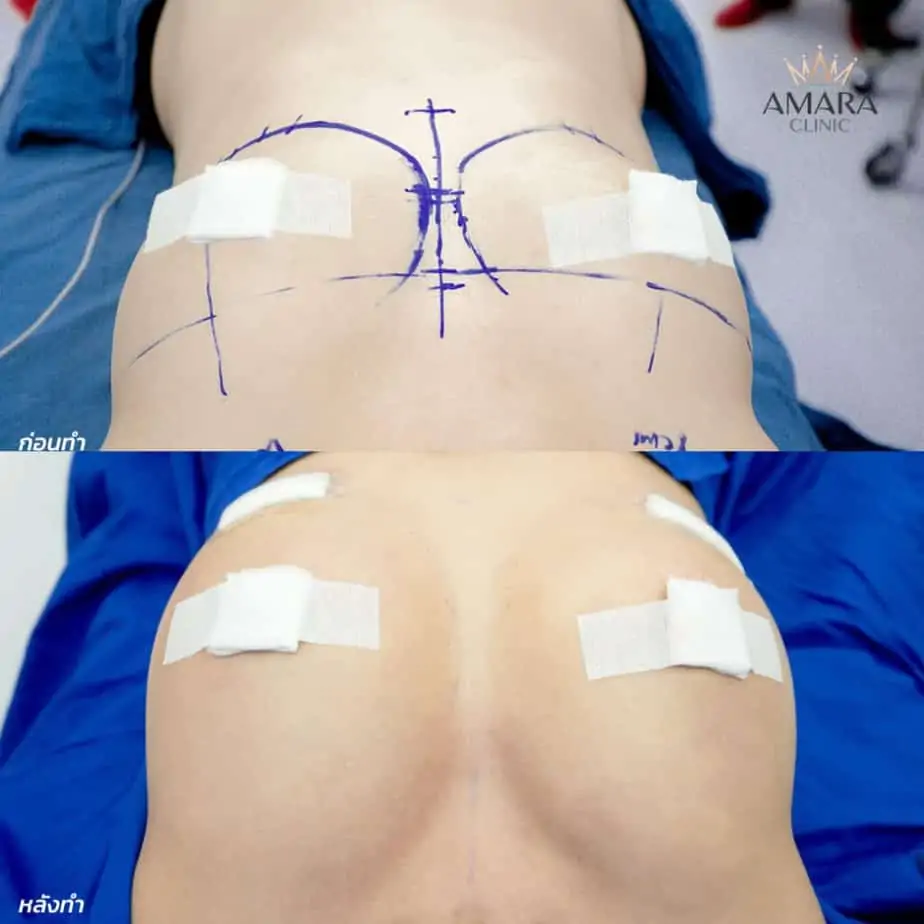 ดูดไขมัน เติมไขมัน Amara Liposuction Center (เอมาร่า คลินิก) โดยแพทย์ผู้มีประสบการณ์
