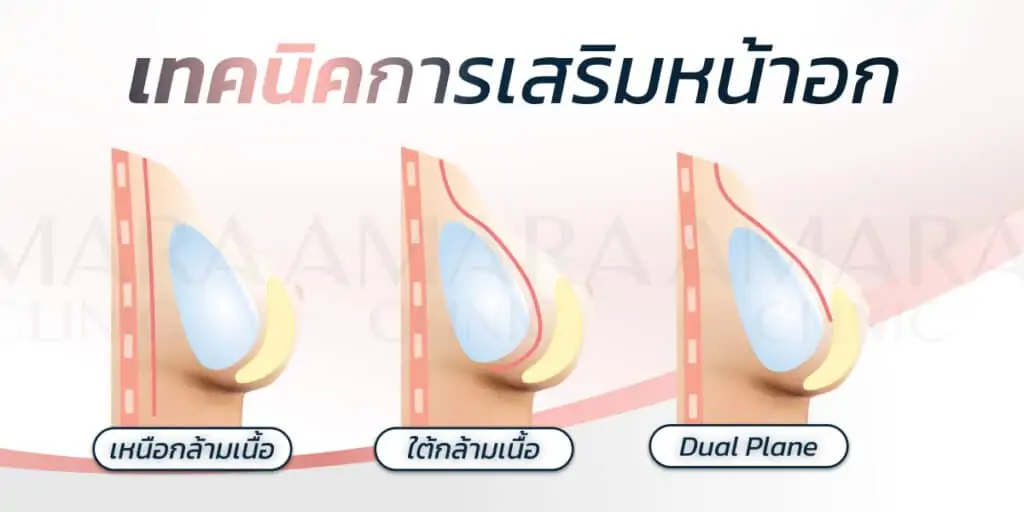 ดูดไขมัน เติมไขมัน Amara Liposuction Center (เอมาร่า คลินิก) โดยแพทย์ผู้มีประสบการณ์