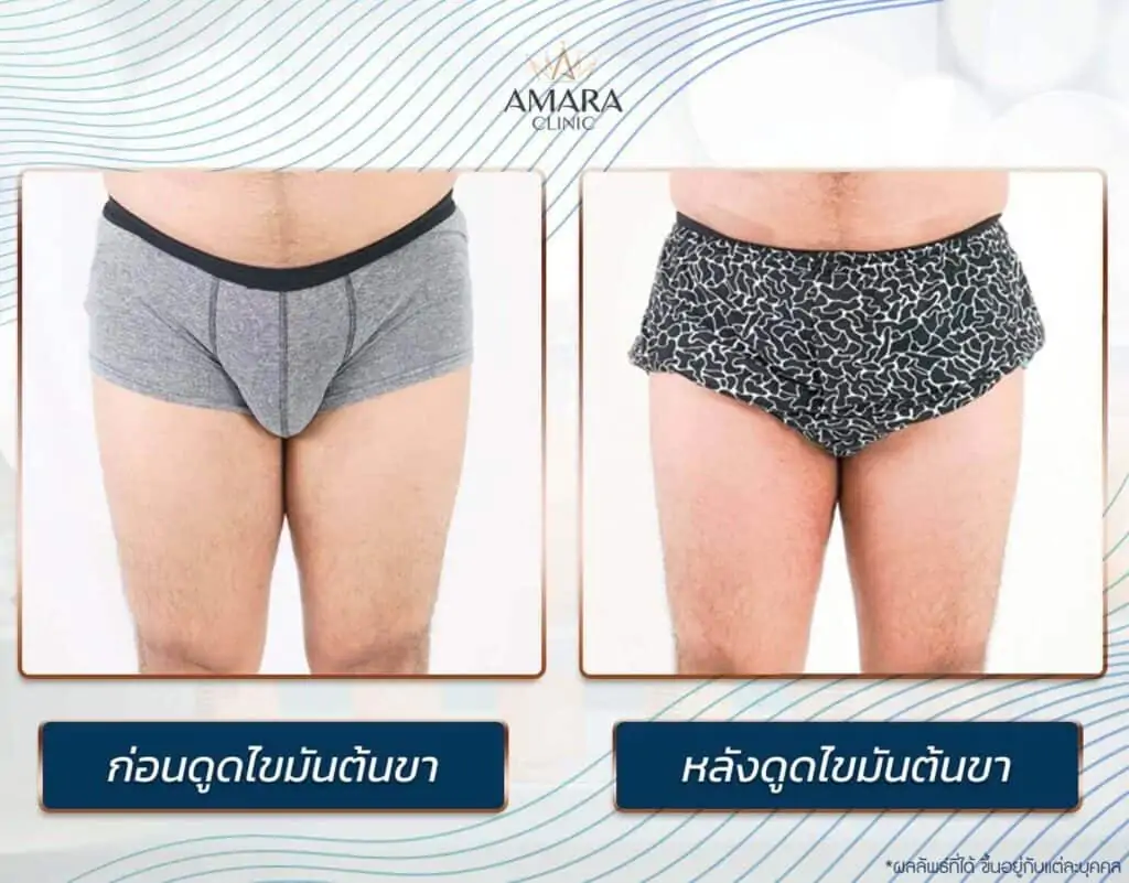 ดูดไขมัน เติมไขมัน Amara Liposuction Center (เอมาร่า คลินิก) โดยแพทย์ผู้มีประสบการณ์