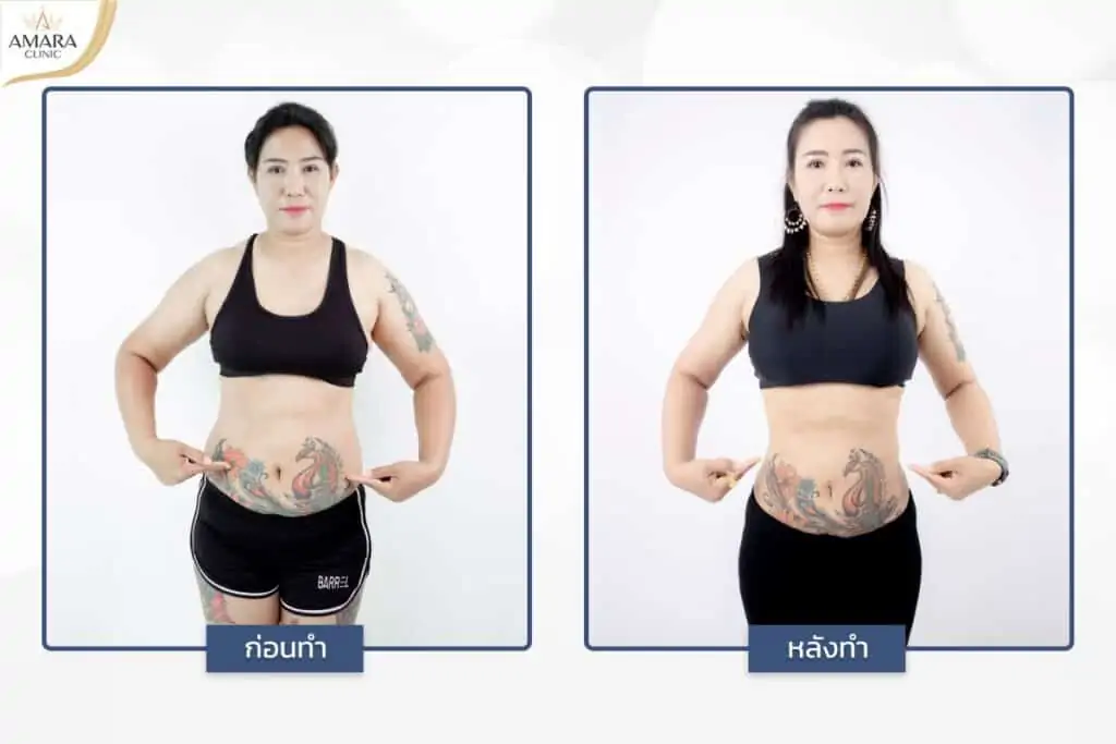 ดูดไขมัน เติมไขมัน Amara Liposuction Center (เอมาร่า คลินิก) โดยแพทย์ผู้มีประสบการณ์