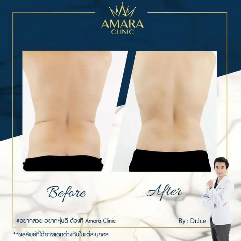 ดูดไขมัน เติมไขมัน Amara Liposuction Center (เอมาร่า คลินิก) โดยแพทย์ผู้มีประสบการณ์