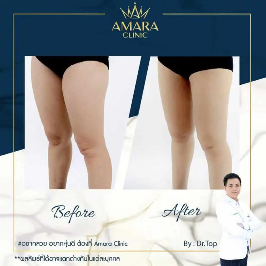 ดูดไขมัน เติมไขมัน Amara Liposuction Center (เอมาร่า คลินิก) โดยแพทย์ผู้มีประสบการณ์