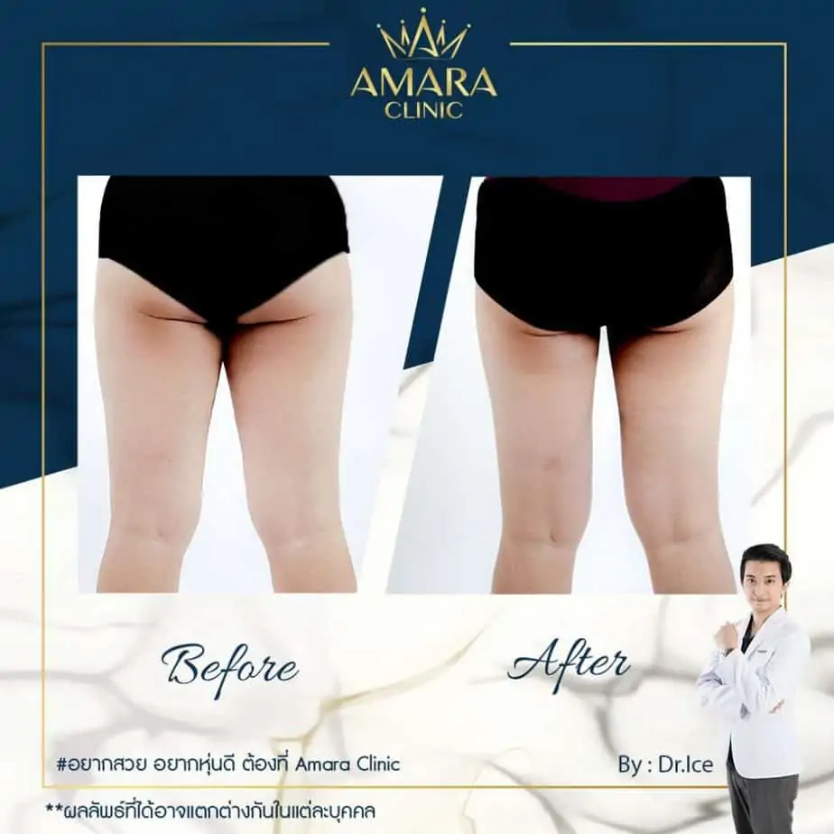 ดูดไขมัน เติมไขมัน Amara Liposuction Center (เอมาร่า คลินิก) โดยแพทย์ผู้มีประสบการณ์