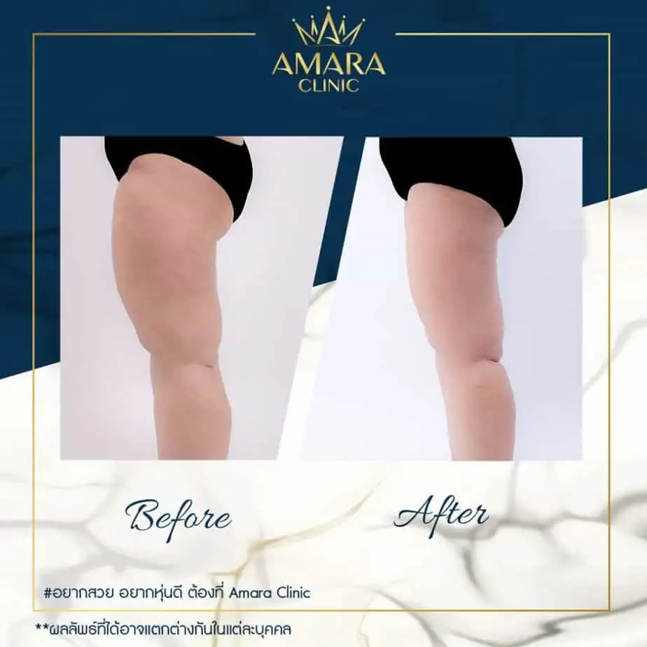 ดูดไขมัน เติมไขมัน Amara Liposuction Center (เอมาร่า คลินิก) โดยแพทย์ผู้มีประสบการณ์