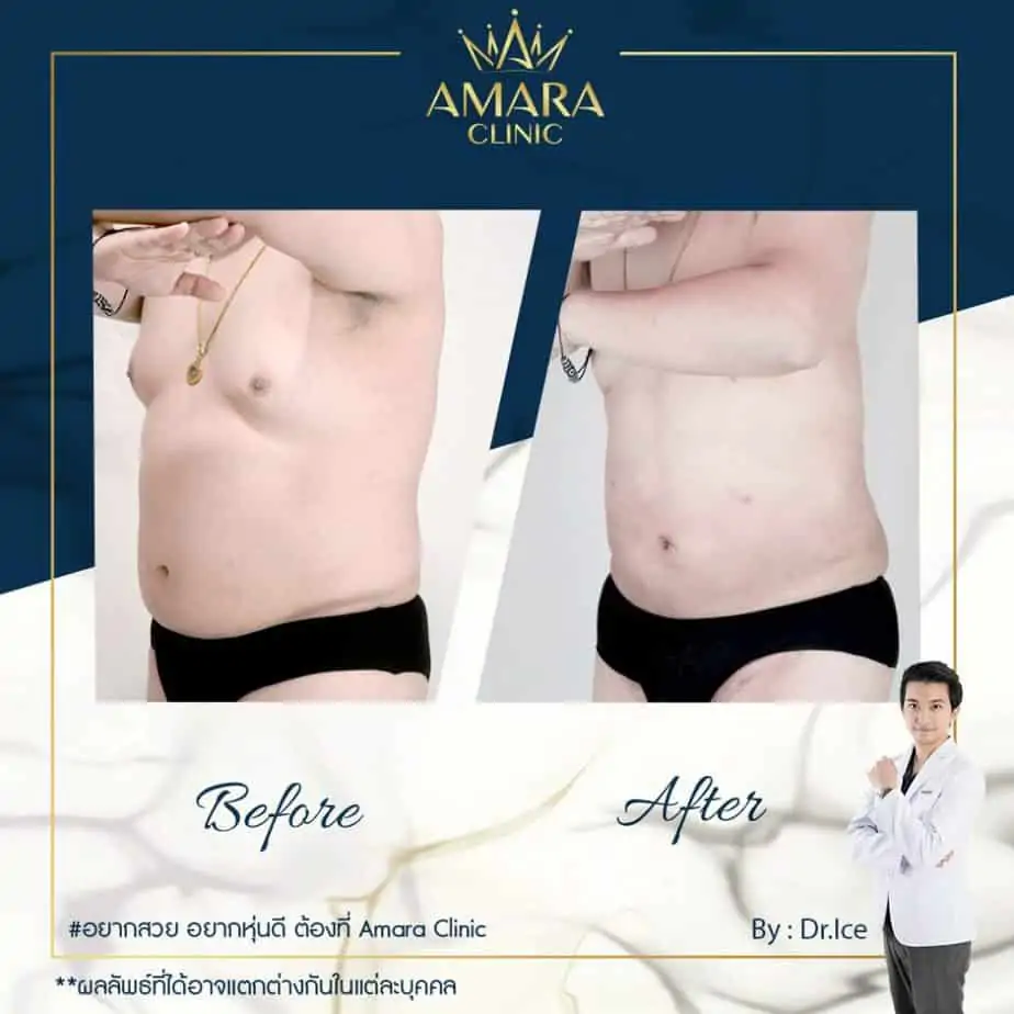 ดูดไขมัน เติมไขมัน Amara Liposuction Center (เอมาร่า คลินิก) โดยแพทย์ผู้มีประสบการณ์