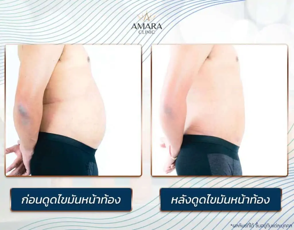 ดูดไขมัน เติมไขมัน Amara Liposuction Center (เอมาร่า คลินิก) โดยแพทย์ผู้มีประสบการณ์