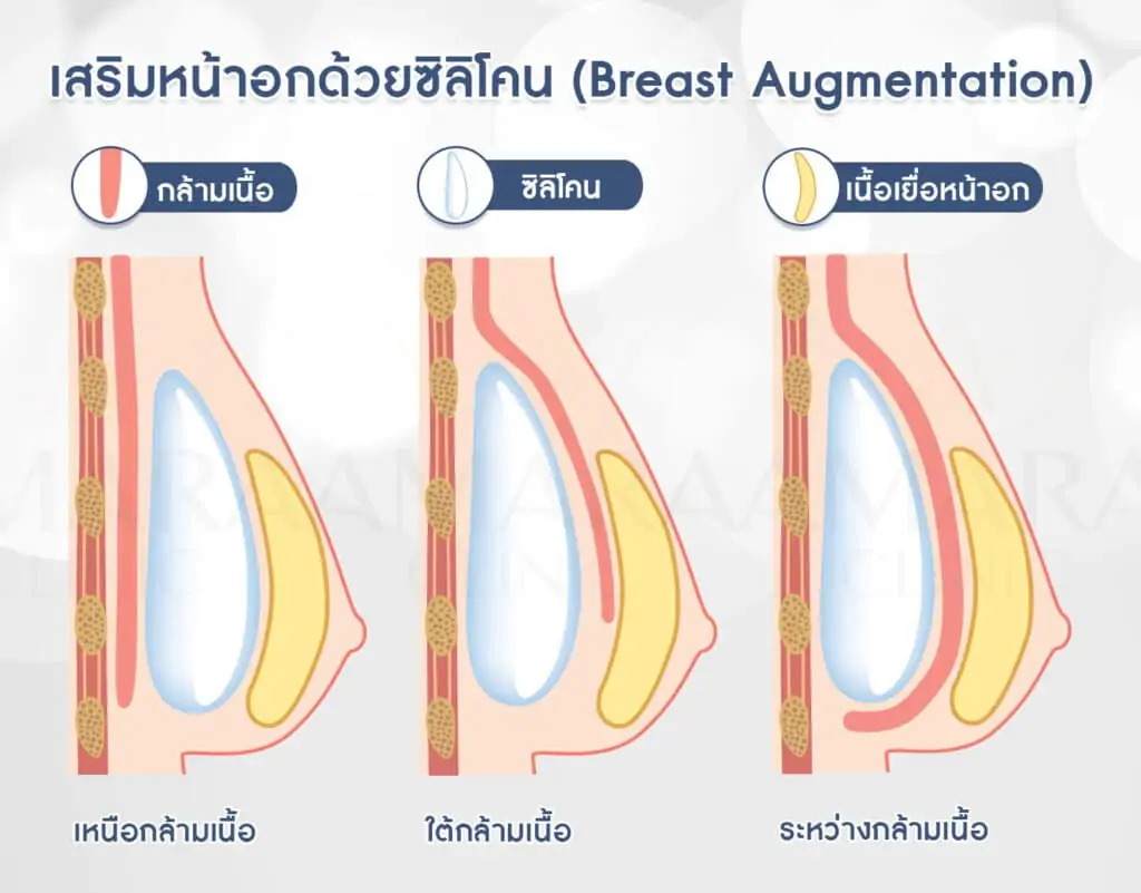 ดูดไขมัน เติมไขมัน Amara Liposuction Center (เอมาร่า คลินิก) โดยแพทย์ผู้มีประสบการณ์