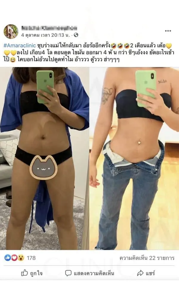 ดูดไขมัน เติมไขมัน Amara Liposuction Center (เอมาร่า คลินิก) โดยแพทย์ผู้มีประสบการณ์