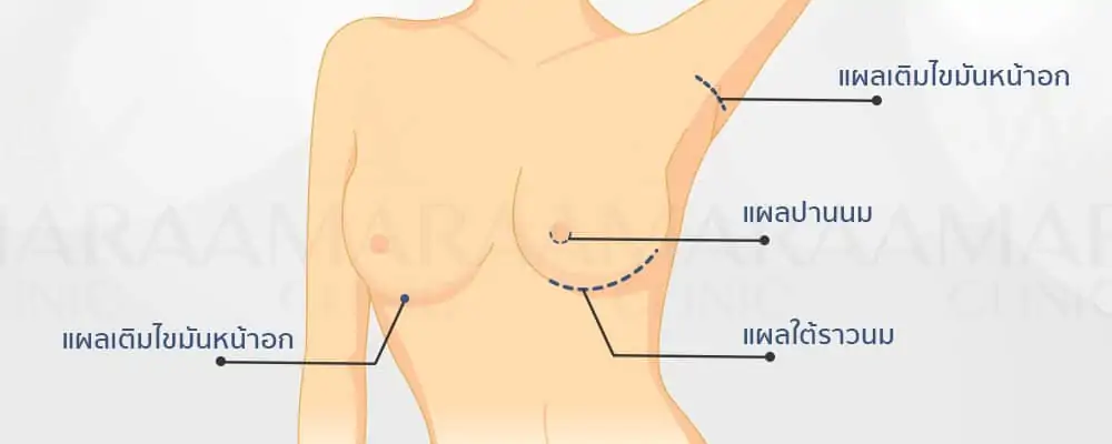 ดูดไขมัน เติมไขมัน Amara Liposuction Center (เอมาร่า คลินิก) โดยแพทย์ผู้มีประสบการณ์