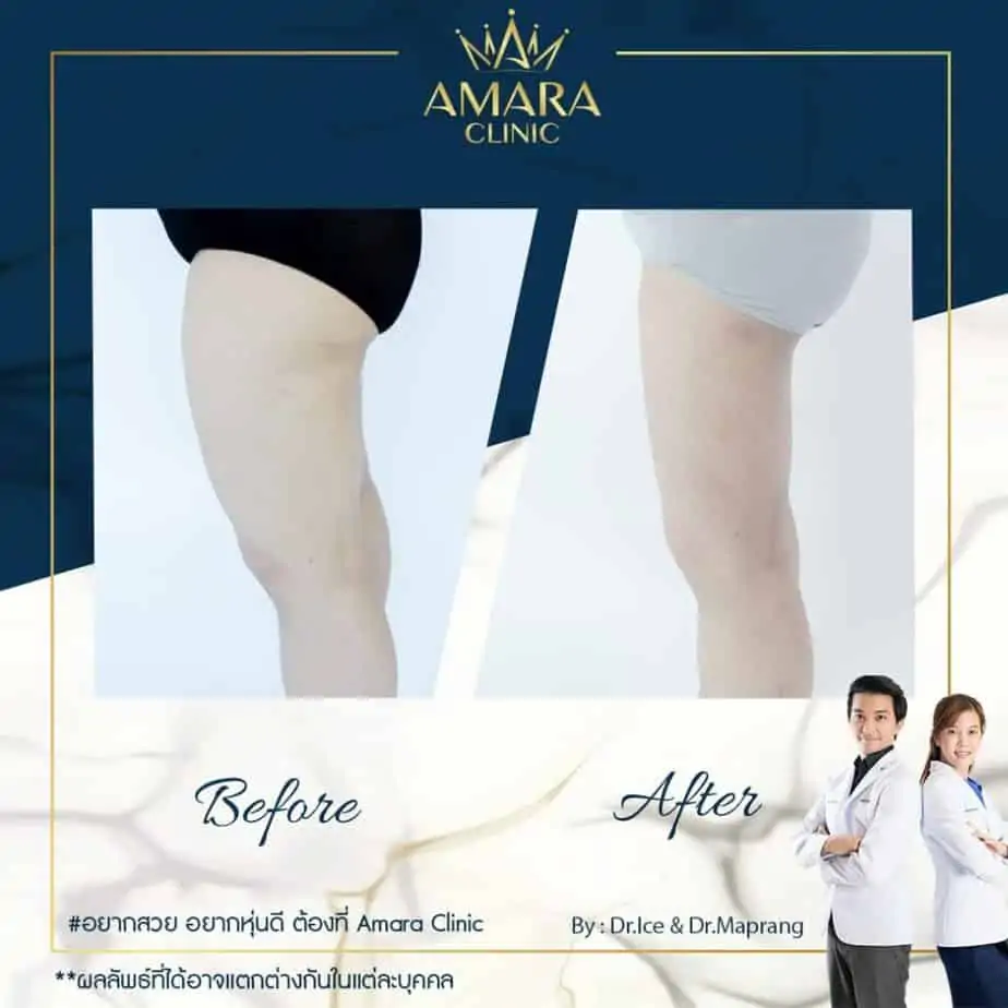 ดูดไขมัน เติมไขมัน Amara Liposuction Center (เอมาร่า คลินิก) โดยแพทย์ผู้มีประสบการณ์