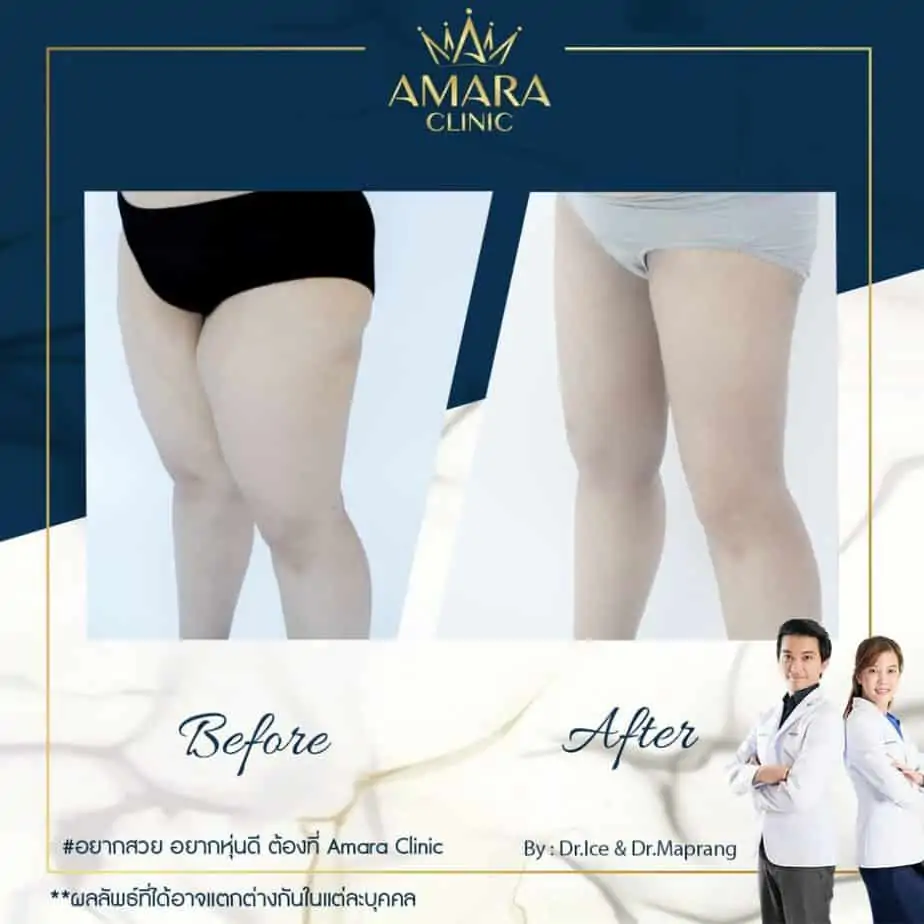 ดูดไขมัน เติมไขมัน Amara Liposuction Center (เอมาร่า คลินิก) โดยแพทย์ผู้มีประสบการณ์