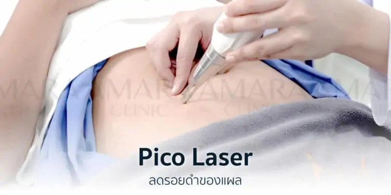 Pico Laser