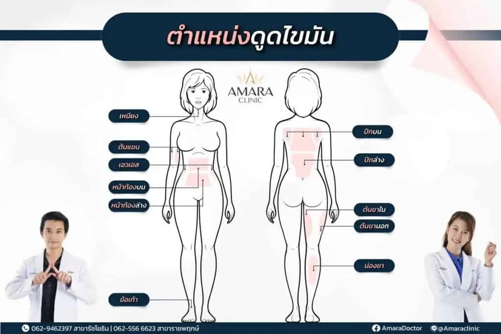 ดูดไขมัน เติมไขมัน Amara Liposuction Center (เอมาร่า คลินิก) โดยแพทย์ผู้มีประสบการณ์