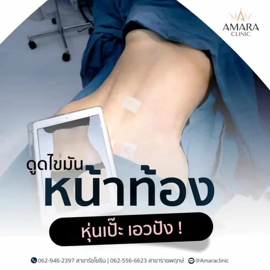 ดูดไขมัน เติมไขมัน Amara Liposuction Center (เอมาร่า คลินิก) โดยแพทย์ผู้มีประสบการณ์