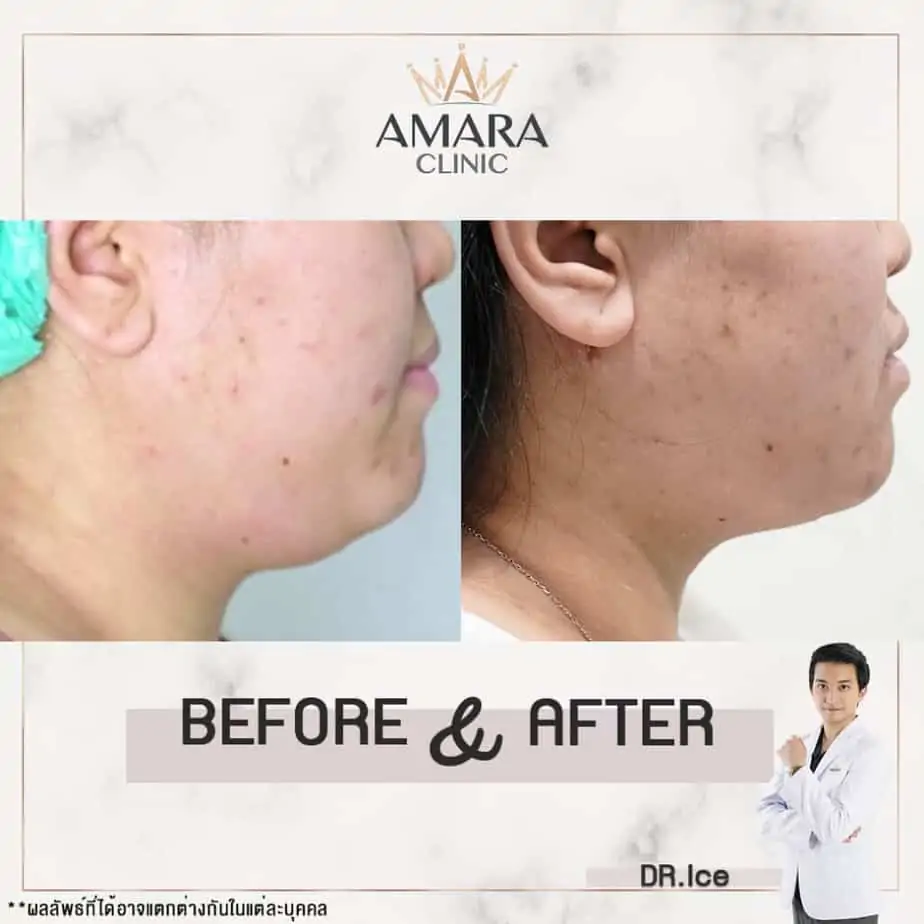 ดูดไขมัน เติมไขมัน Amara Liposuction Center (เอมาร่า คลินิก) โดยแพทย์ผู้มีประสบการณ์