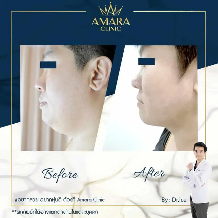 ดูดไขมัน เติมไขมัน Amara Liposuction Center (เอมาร่า คลินิก) โดยแพทย์ผู้มีประสบการณ์