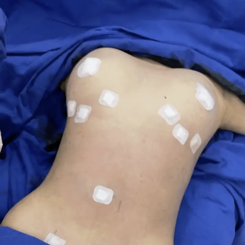 ดูดไขมัน เติมไขมัน Amara Liposuction Center (เอมาร่า คลินิก) โดยแพทย์ผู้มีประสบการณ์