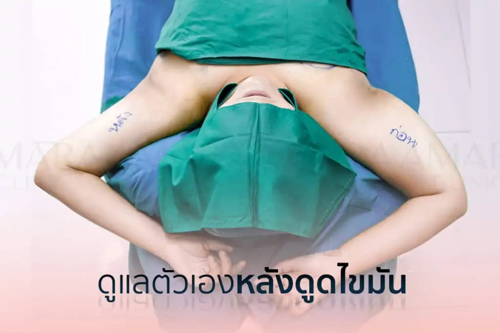 ดูดไขมัน เติมไขมัน Amara Liposuction Center (เอมาร่า คลินิก) โดยแพทย์ผู้มีประสบการณ์