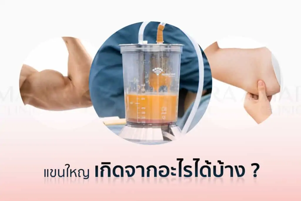 ดูดไขมัน เติมไขมัน Amara Liposuction Center (เอมาร่า คลินิก) โดยแพทย์ผู้มีประสบการณ์