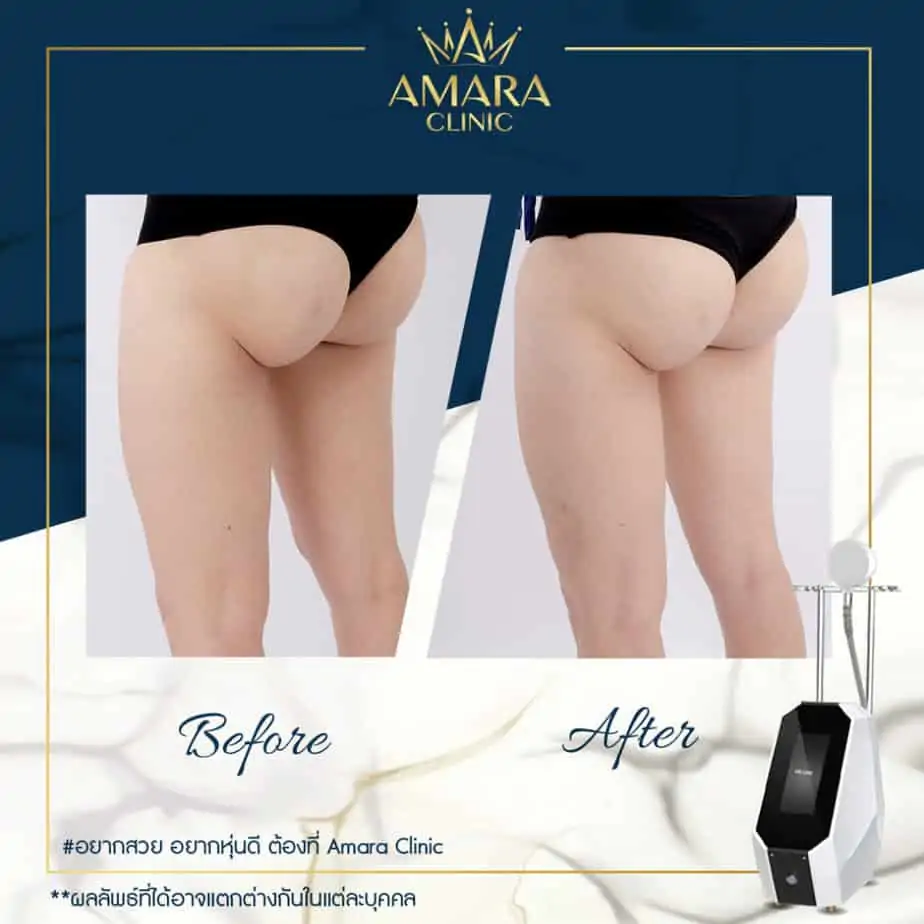 ดูดไขมัน เติมไขมัน Amara Liposuction Center (เอมาร่า คลินิก) โดยแพทย์ผู้มีประสบการณ์