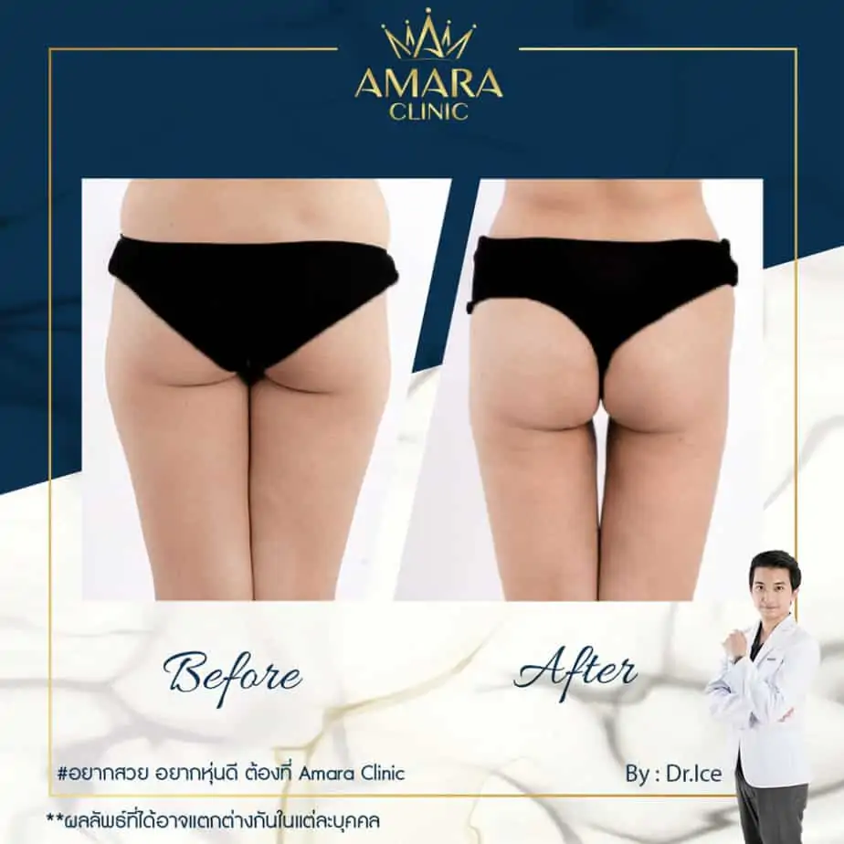 ดูดไขมัน เติมไขมัน Amara Liposuction Center (เอมาร่า คลินิก) โดยแพทย์ผู้มีประสบการณ์