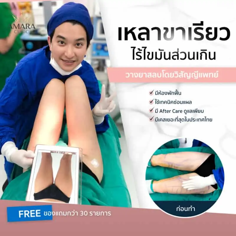 รีวิวดูดไขมันต้นขา