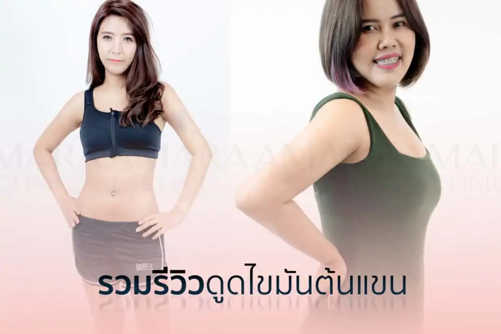 ดูดไขมัน เติมไขมัน Amara Liposuction Center (เอมาร่า คลินิก) โดยแพทย์ผู้มีประสบการณ์