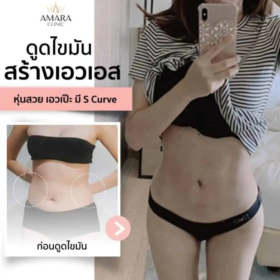 ดูดไขมัน เติมไขมัน Amara Liposuction Center (เอมาร่า คลินิก) โดยแพทย์ผู้มีประสบการณ์