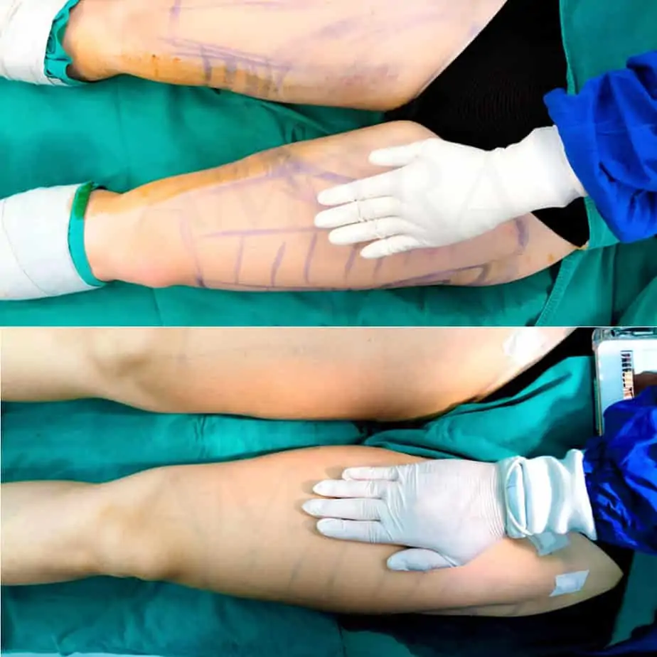 ดูดไขมัน เติมไขมัน Amara Liposuction Center (เอมาร่า คลินิก) โดยแพทย์ผู้มีประสบการณ์