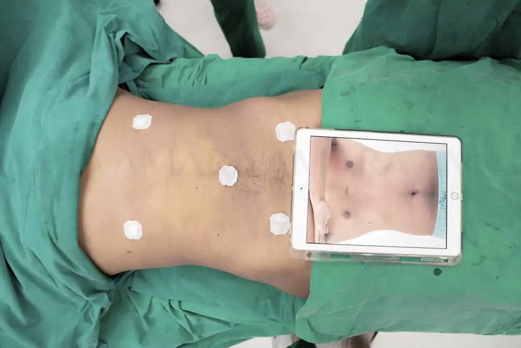 ดูดไขมัน เติมไขมัน Amara Liposuction Center (เอมาร่า คลินิก) โดยแพทย์ผู้มีประสบการณ์