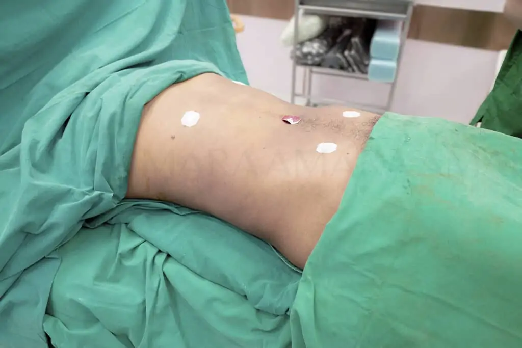 ดูดไขมัน เติมไขมัน Amara Liposuction Center (เอมาร่า คลินิก) โดยแพทย์ผู้มีประสบการณ์