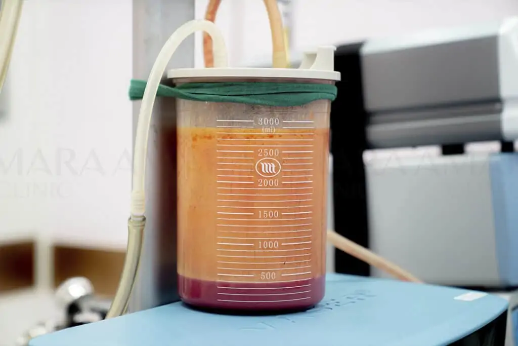 ดูดไขมัน เติมไขมัน Amara Liposuction Center (เอมาร่า คลินิก) โดยแพทย์ผู้มีประสบการณ์