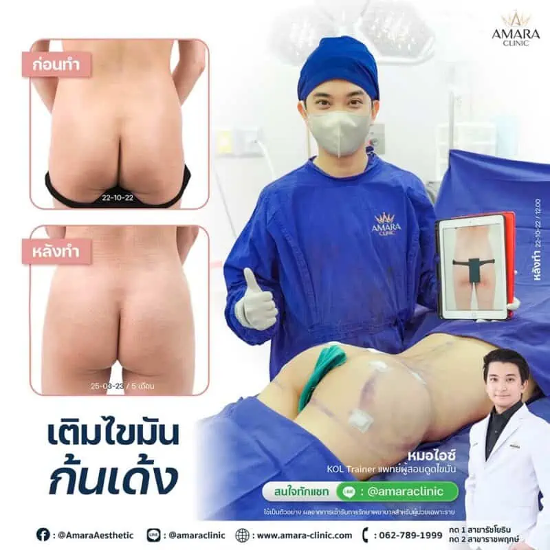 ฉีดไขมันก้นเด้ง Brazilian Butt Lift