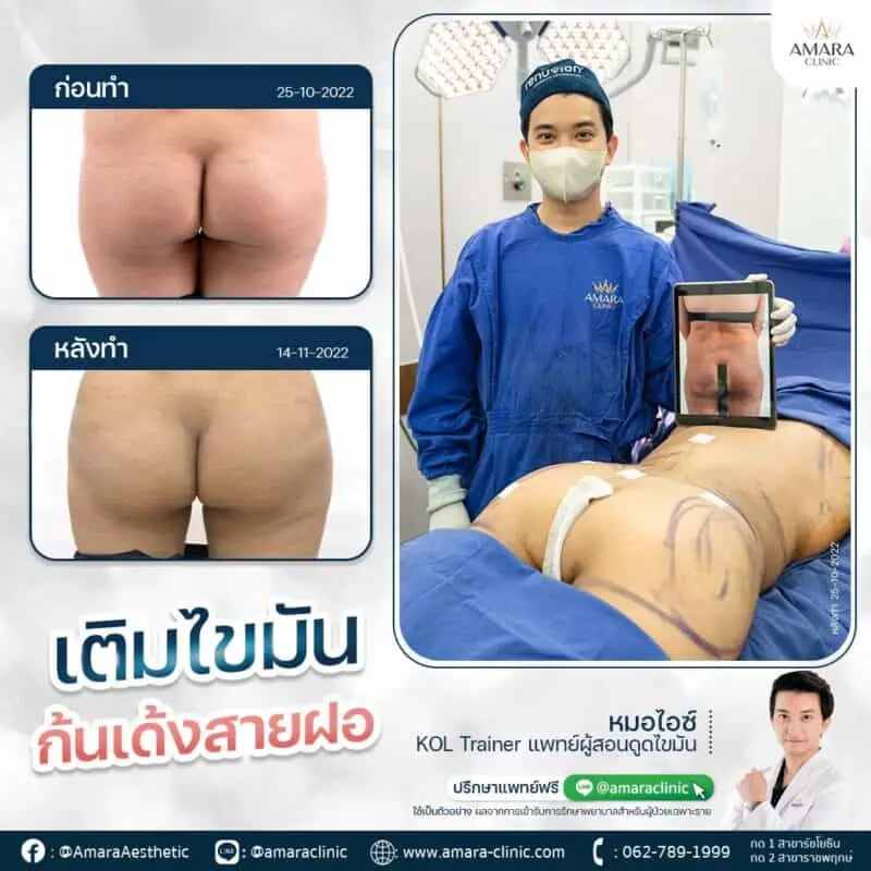 เติมไขมันก้น Brazilian Butt Lift