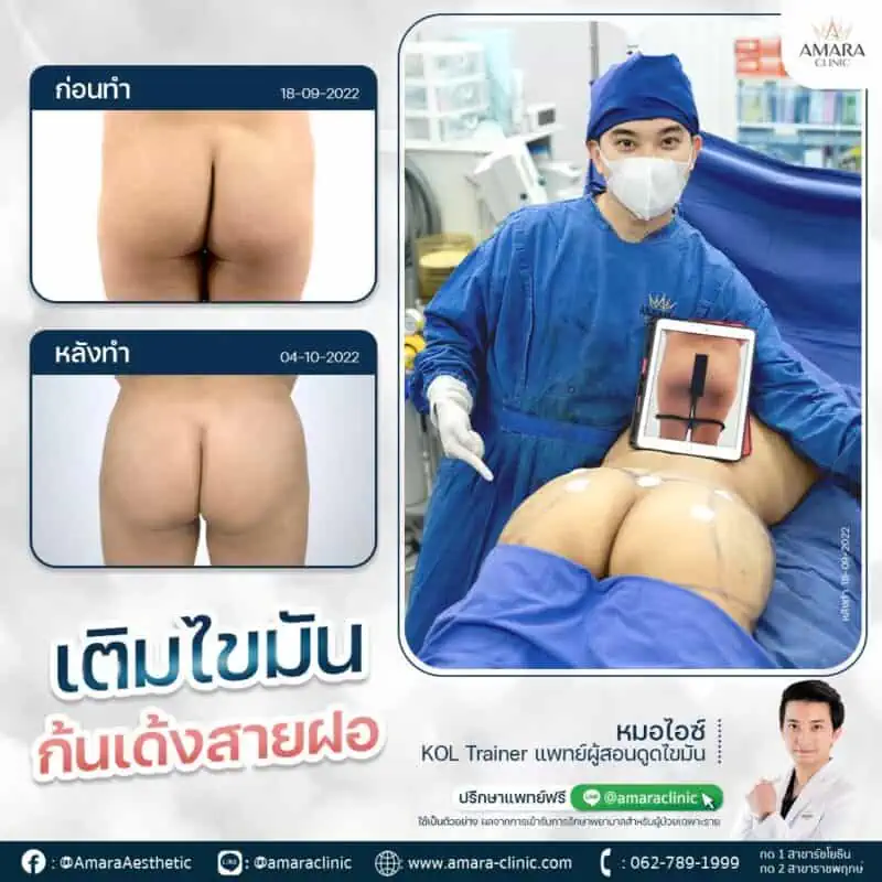 ฉีดไขมันก้น ฉีดไขมันสะโพก Brazilian Butt Lift