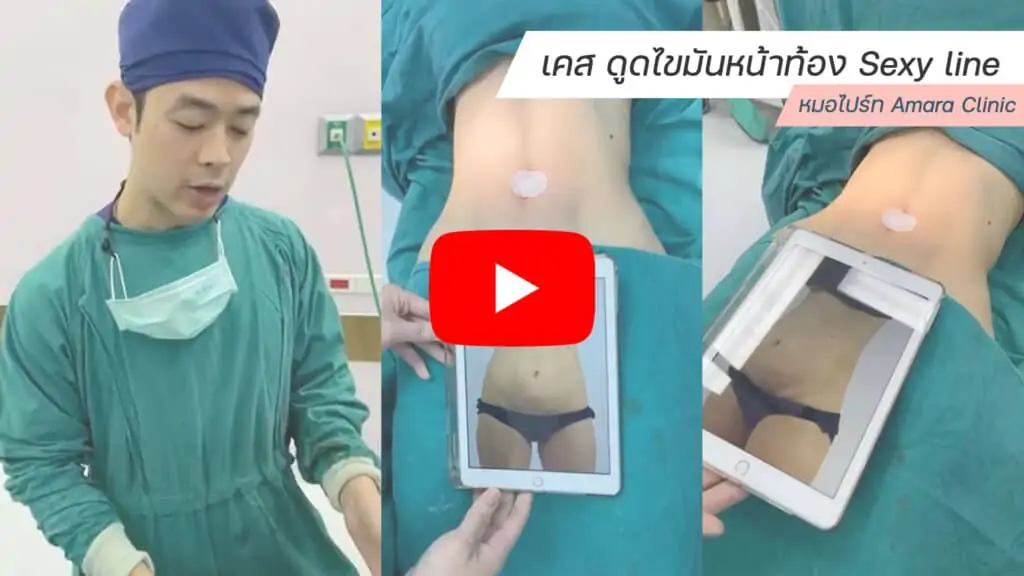 ดูดไขมัน เติมไขมัน Amara Liposuction Center (เอมาร่า คลินิก) โดยแพทย์ผู้มีประสบการณ์