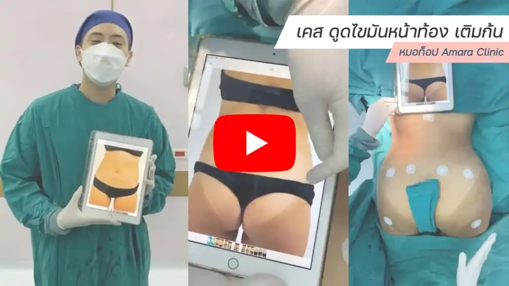 ดูดไขมัน เติมไขมัน Amara Liposuction Center (เอมาร่า คลินิก) โดยแพทย์ผู้มีประสบการณ์