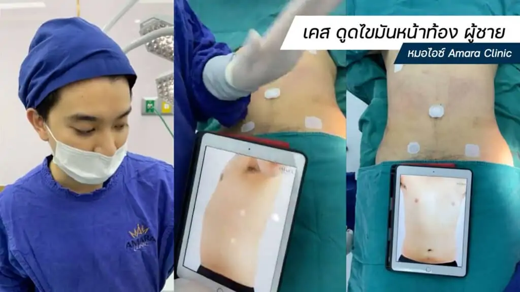ดูดไขมัน เติมไขมัน Amara Liposuction Center (เอมาร่า คลินิก) โดยแพทย์ผู้มีประสบการณ์